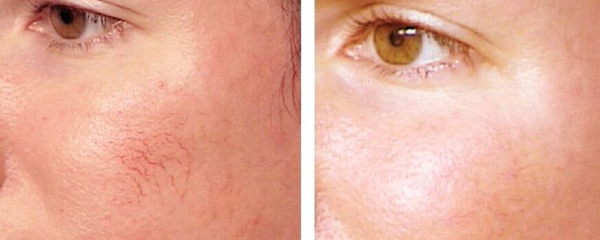 การกำจัด rosacea