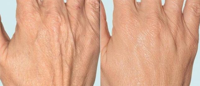 ผิวหนังมือก่อนและหลังการบำบัดแบบเศษส่วน